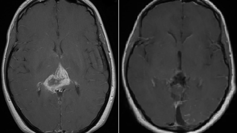 אישה survives deadly brain tumor.