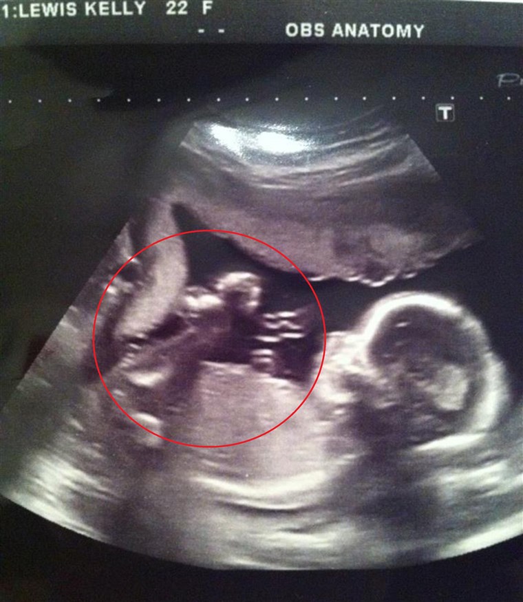 לואיס' ultrasound