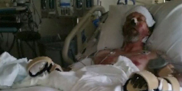 מערב Bend lost both hands and both lower legs to amputation to save his life.