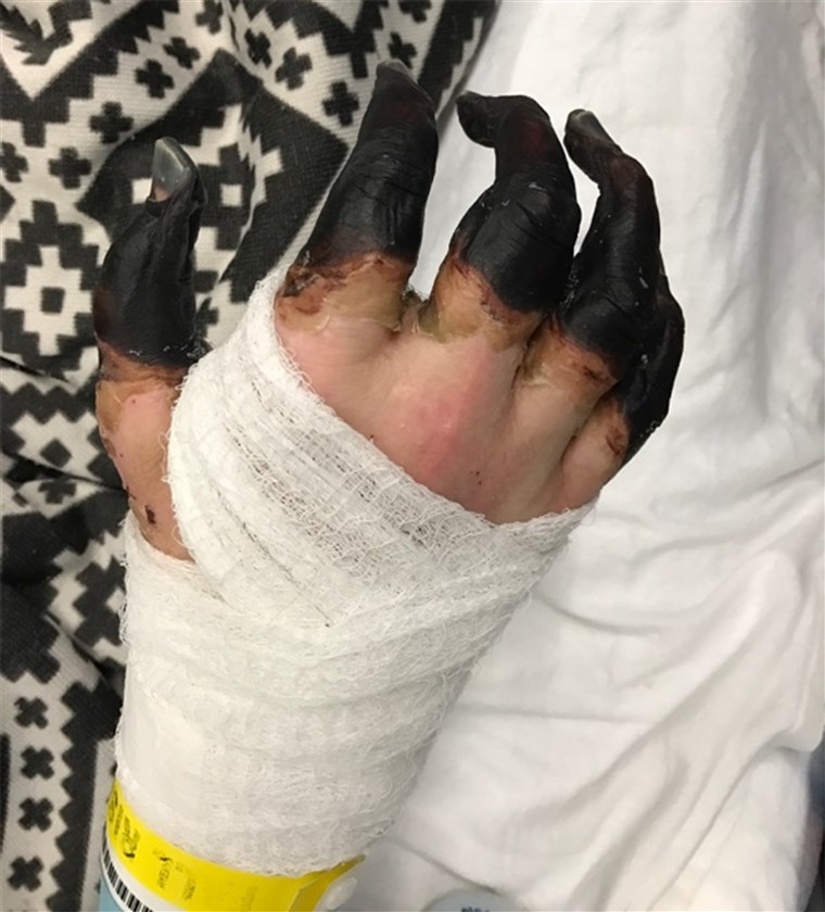ברין's hands turned black as a result of his infection and may have to be amputated. 