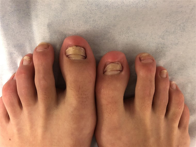onychomadesis after a fish pedicure