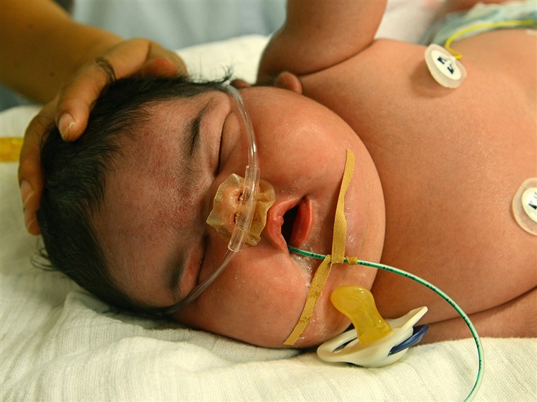 जर्मनी's heaviest newborn, baby girl Jasleen, is in the neonatal intensive care ward of the University Hospital in Leipzig, Germany.