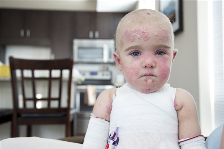 17 महीने पुराने Elisa McCann is living with Epidermolysis Bullosa, a rare and debilitating skin disease. Her condition has been rapidly improving after s...