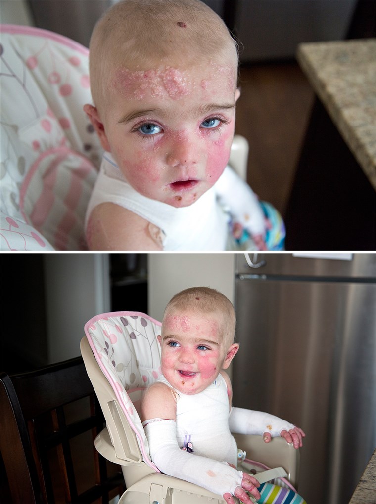 17 महीने पुराने Elisa McCann is living with Epidermolysis Bullosa, a rare and debilitating skin disease. Her condition has been rapidly improving after s...