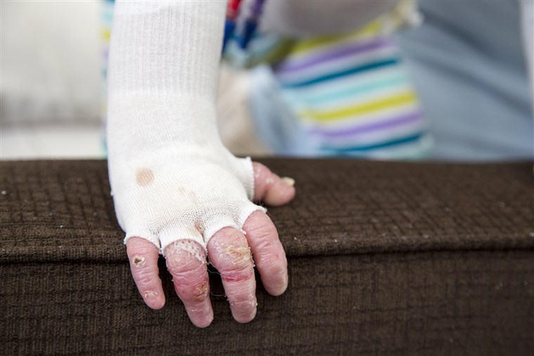 בן 17 חודשים Elisa McCann is living with Epidermolysis Bullosa, a rare and debilitating skin disease. Her condition has been rapidly improving after s...