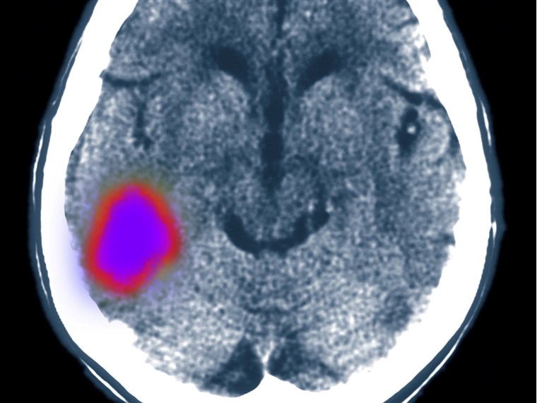 מוחי CT scan showing stroke
