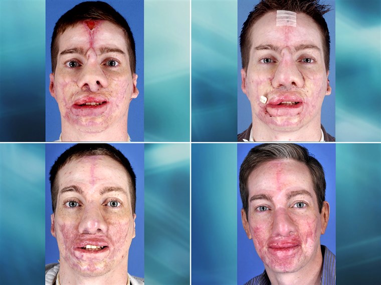 MINKET. Marine corporal Aaron Mankin's face has undergone a remarkable transformation thanks to more than 60 surgeries by the surgeons in Operation Mend at UCLA Medical Center. 