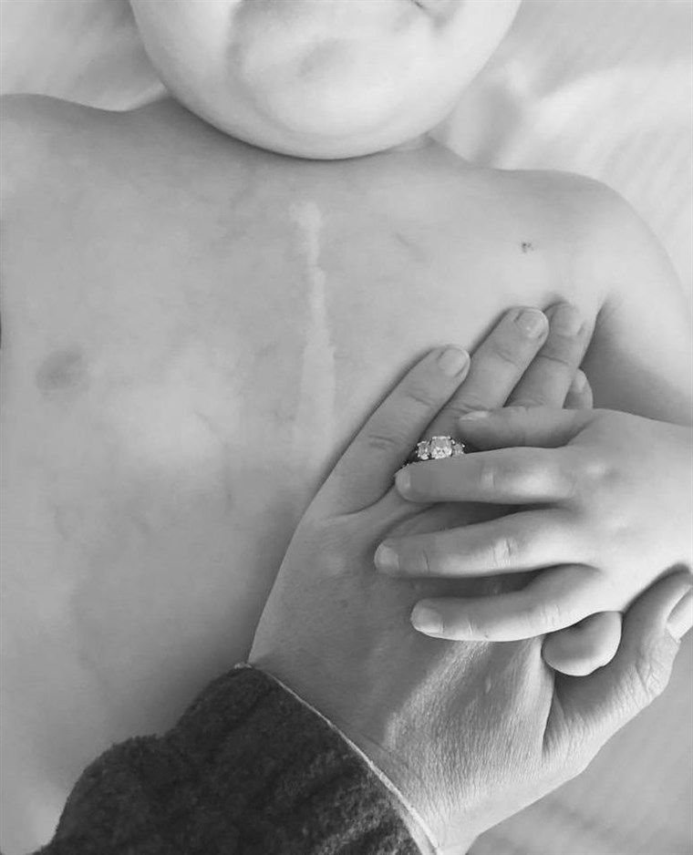 में one of the touching posts Blumenthal uploaded to Facebook, she reflects on Finn's scar from his initial open heart surgery.