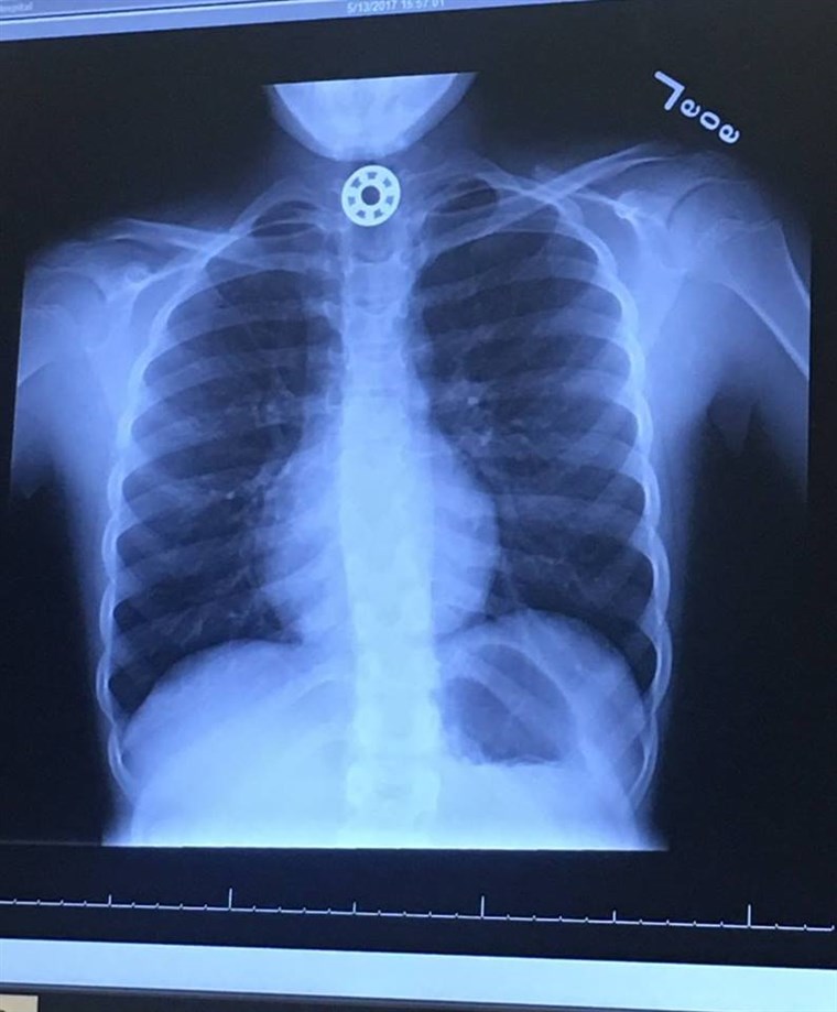 קלי Rose Joniec's daughter accidentally swallowed part of a fidget spinner