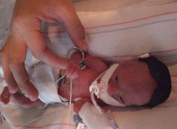 चेल्सी Arledge's son, Travis, was born premature at 23 weeks gestation in 2008. 
