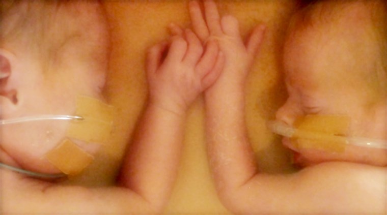 נולד prematurely at 27 weeks, twins Emily and Jamie made a dramatic entrance. Jamie was declared dead shortly after birth, but revived after cuddling skin-to-skin with his mother.