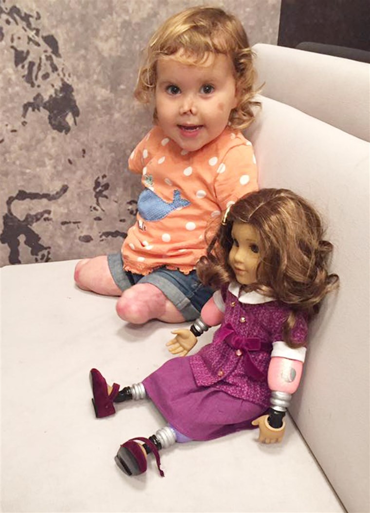 Négyszeres amputált toddler receives look-alike doll.