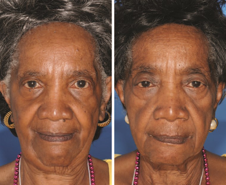 A twin on the left is a nonsmoker and the twin on the right smoked for 29 years. Note the differences in periorbital aging.