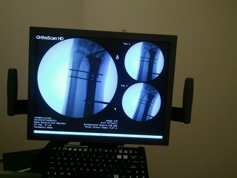 טרייסי rodgers X-ray