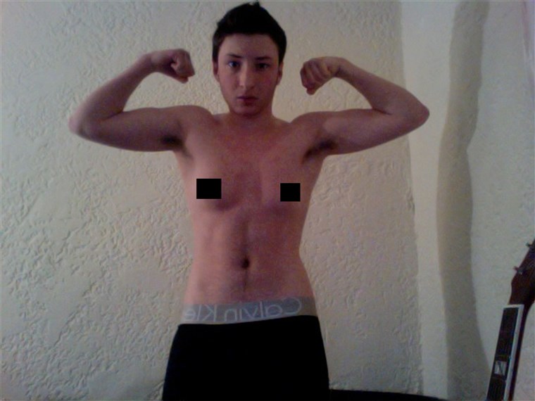 एश्टन Colby, age 21, after five months on testosterone and before his double mastectomy.