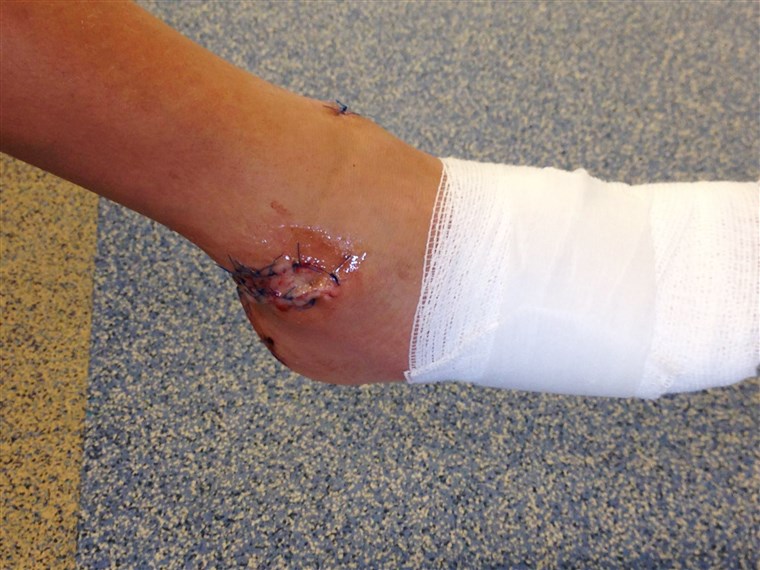 סבסטיאן Cozzan's wound after he was bitten by a shark on March 21 in North Palm Beach, Fla. He received 80 stiches.
